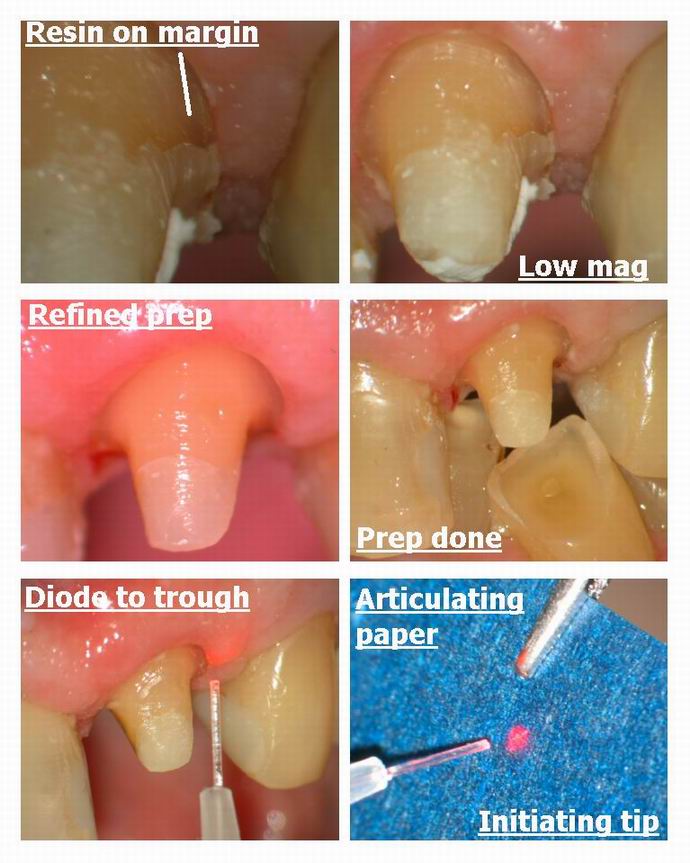 Resize of Crown prep Collage pg 2.jpg